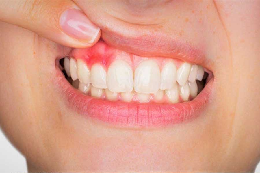 Troubled Gums? Overcome Gum Disease With Vitamin C